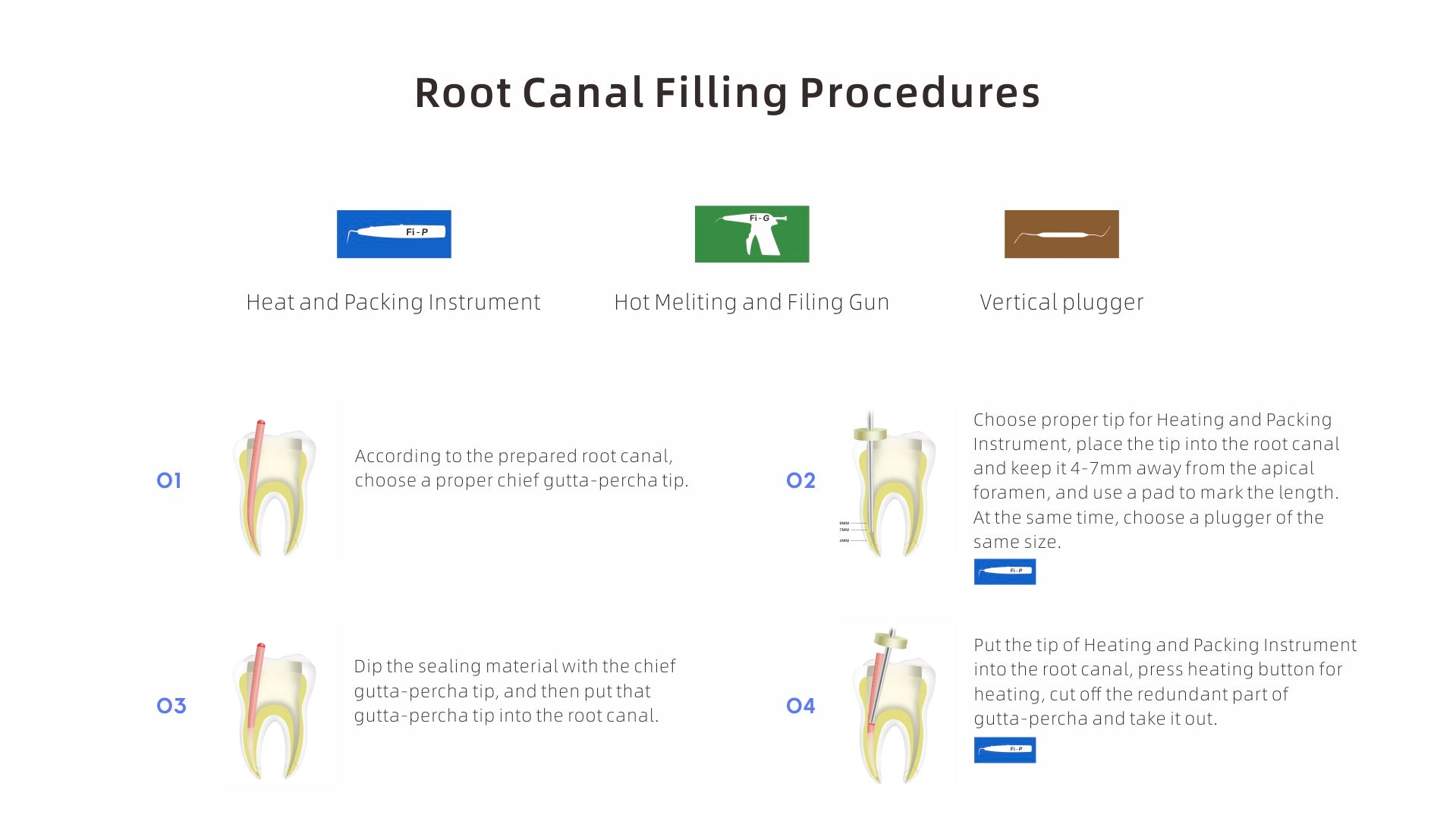 Step-by-step root canal filling procedure using the Woodpecker Fi-P gutta-percha obturation system. Includes heat and packing instrument, hot melting and filling gun, and vertical plugger for precise and efficient endodontic treatment.