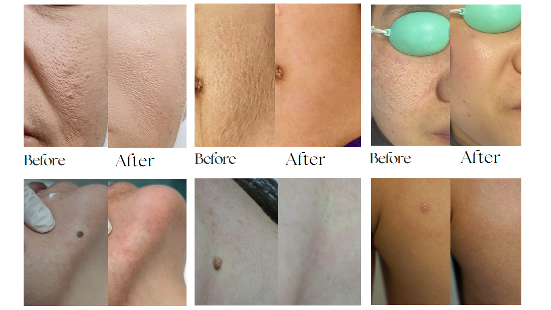 EXFU MDL Fractional CO₂ Laser FG V1