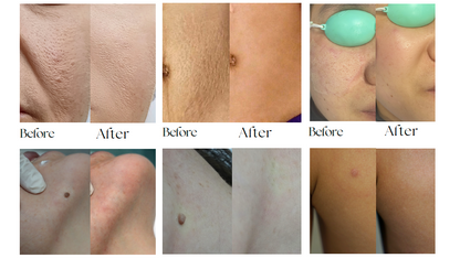 EXFU MDL Fractional CO₂ Laser FG V1