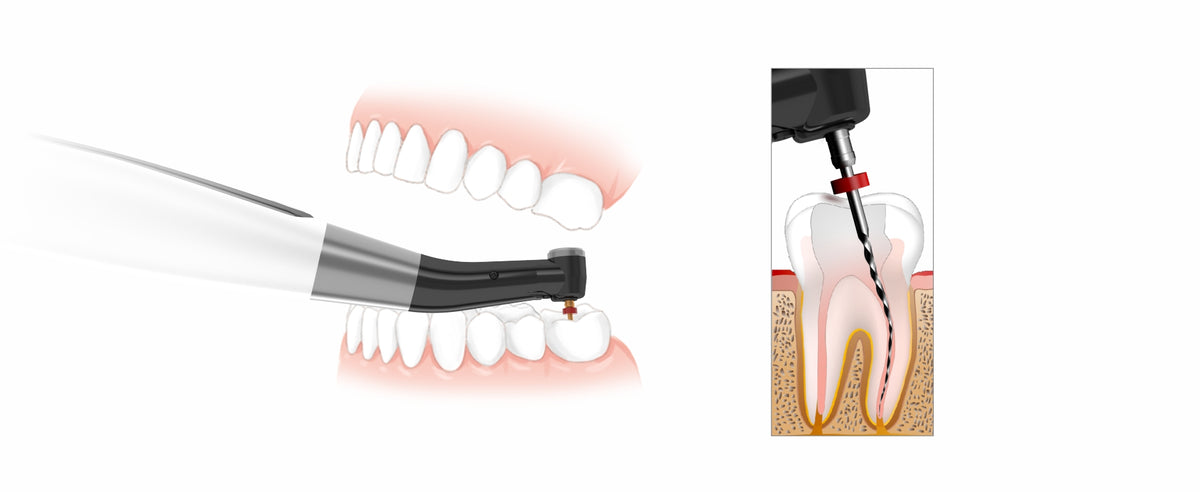 Woodpecker EndoMatic endodontic motor performing root canal treatment with NiTi file